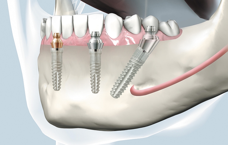 SKY uni.cone abutments - narrow jaws safely fitted with bridges and bars