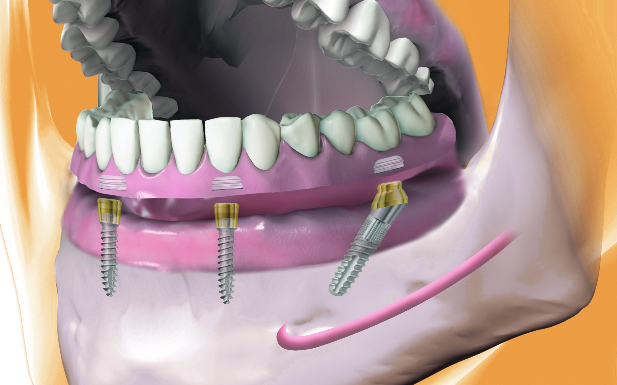 mini2SKY 3.2 - improved stability and more prosthetic options