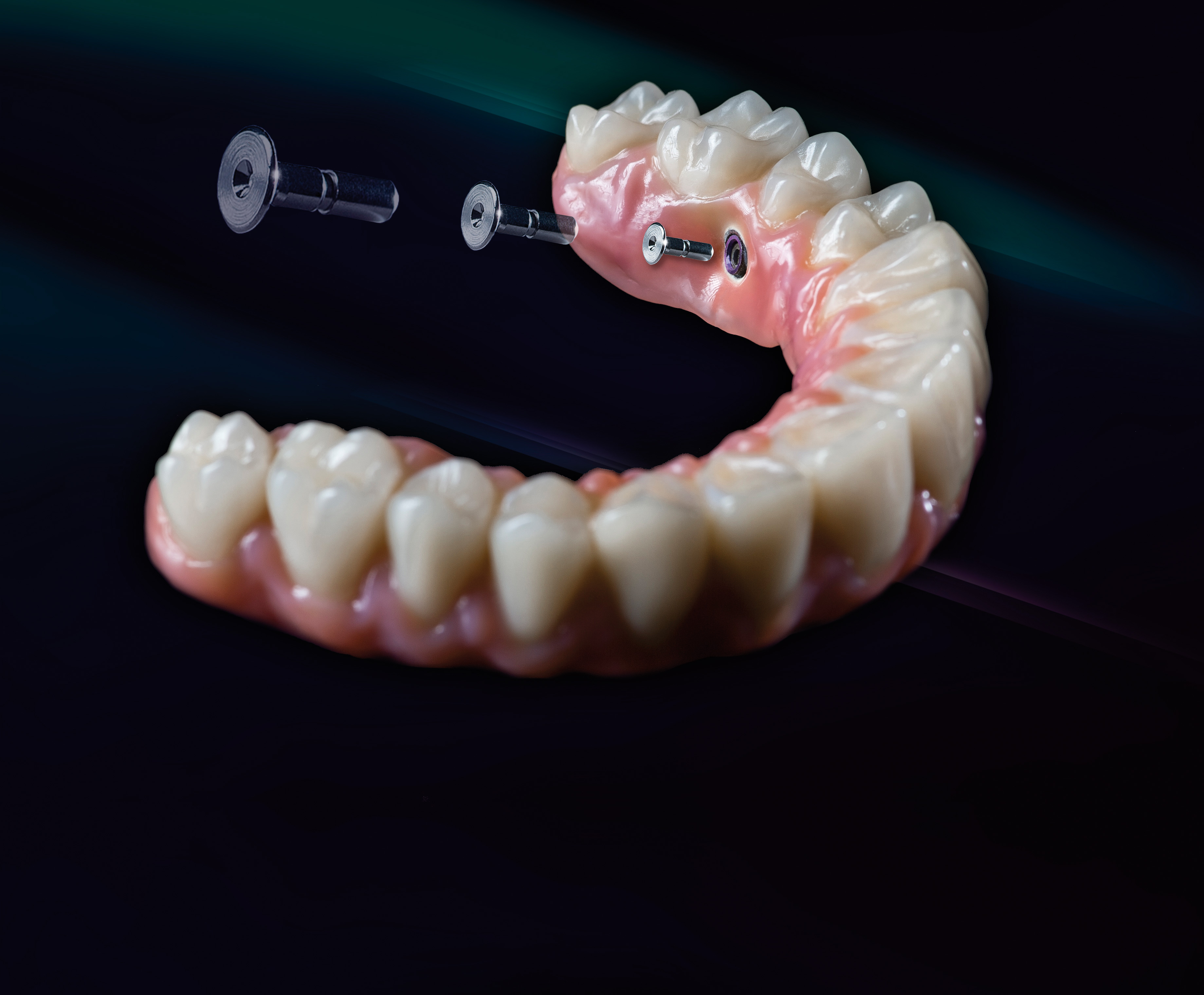 Easy-Snap locking pin: Reliability for dentist and patient