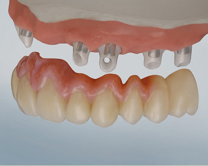 DTK Adhesive - maximum bonding strength even at ambient temperature and with zirconia