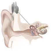 neurostimulation device neurostimulation device