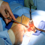 hernia repair hernia repair