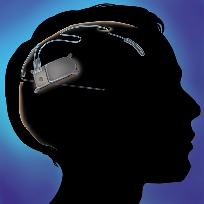 medical implant market