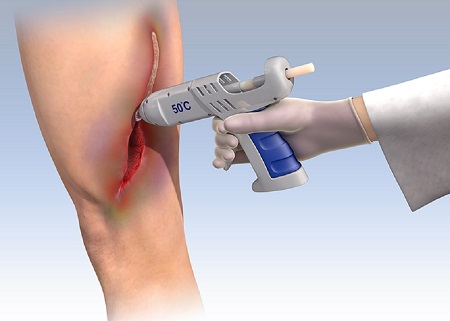 topical skin adhesive market