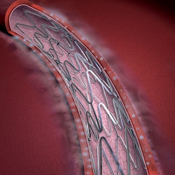 Coronary Stent Market Coronary Stent Market