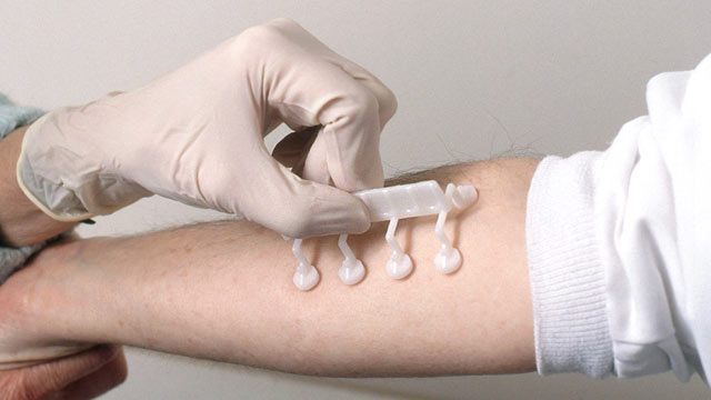 Allergy Diagnostics Market