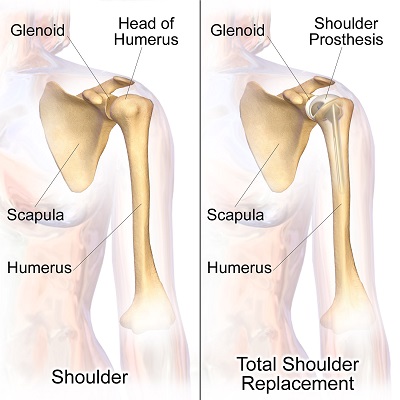 Shoulder Arthroplasty Market Shoulder Arthroplasty Market