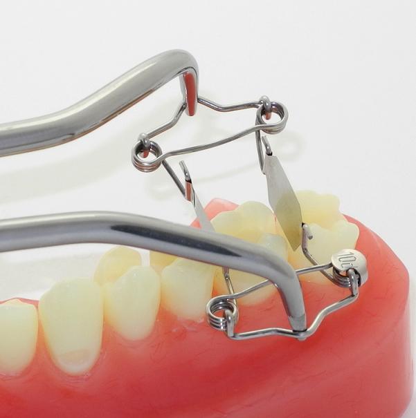 New Walser tooth matrix extra deep caries on one side