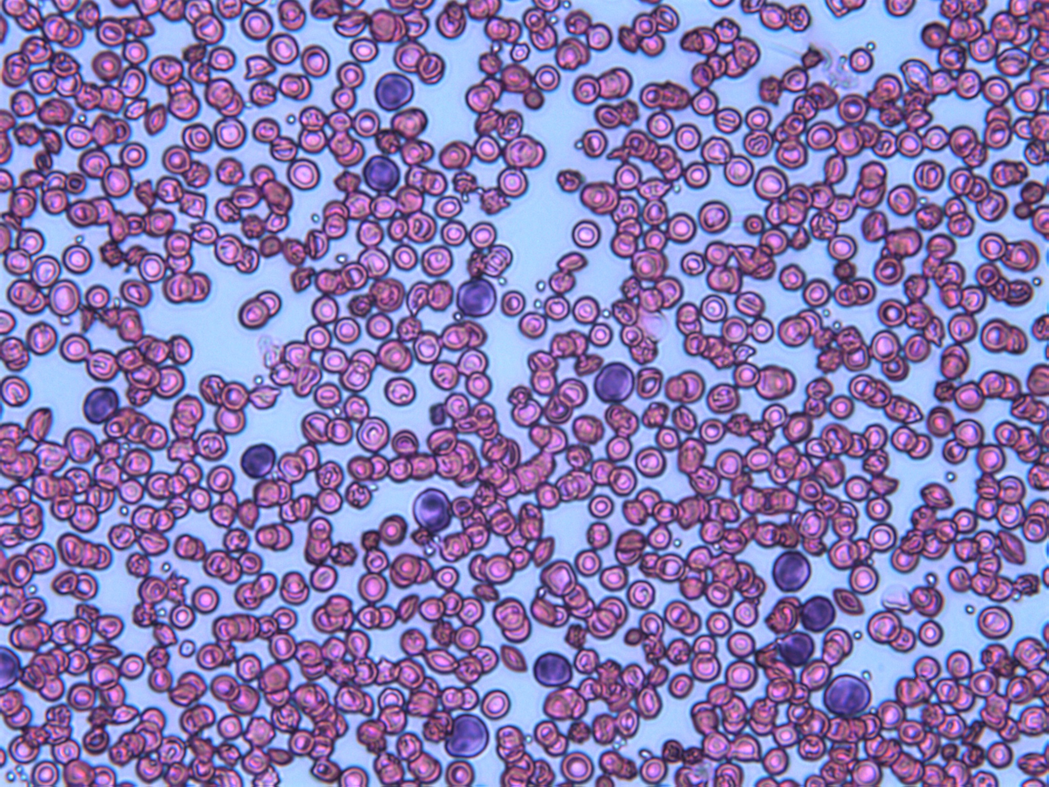 Leukaemia-cells_Copyright Sophie Edtmayer