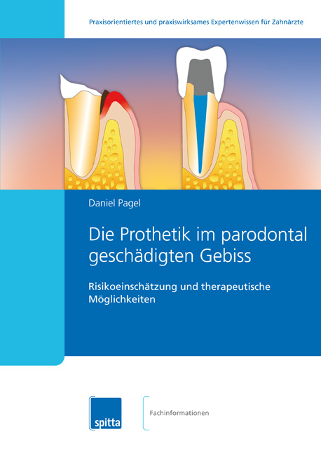 Risikoeinschätzung beim parodontal geschädigten Gebiss vor prothetischen Behandlungen - das neue Fac Risikoeinschätzung beim parodontal geschädigten Gebiss vor prothetischen Behandlungen - das neue Fac
