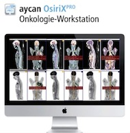 aycan OsiriX PRO in der Onkologie