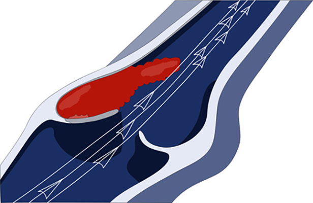 Thrombose: Diagnose und Therapie in München Thrombose: Diagnose und Therapie in München
