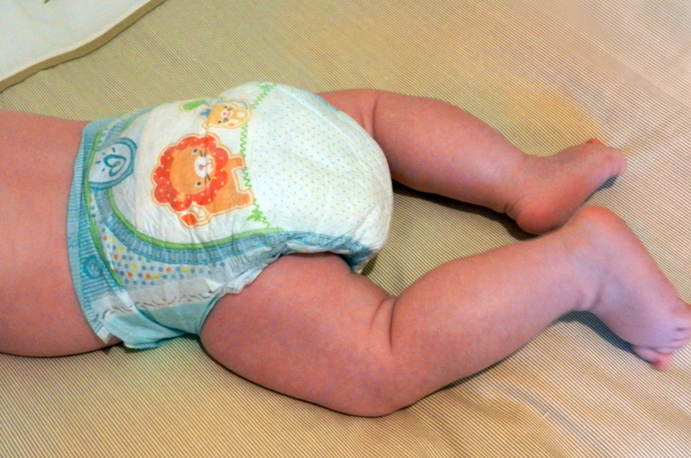 Rund Zweidrittel aller gewickelten Babys sind einmal oderöfter von der Windeldermatitis betroffen Rund Zweidrittel aller gewickelten Babys sind einmal oderöfter von der Windeldermatitis betroffen