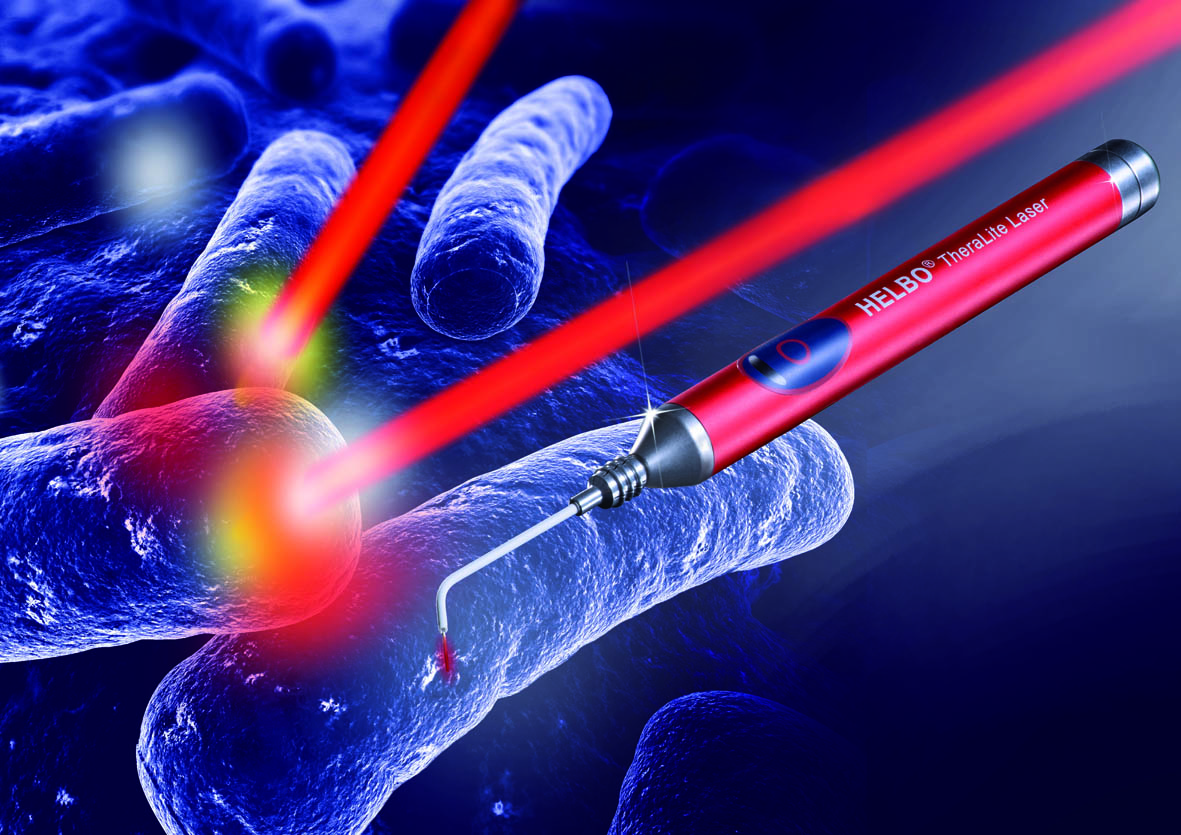 Photodynamik bei Parodontitis- und Periimplantitistherapie mit dem HELBO®-Verfahren
