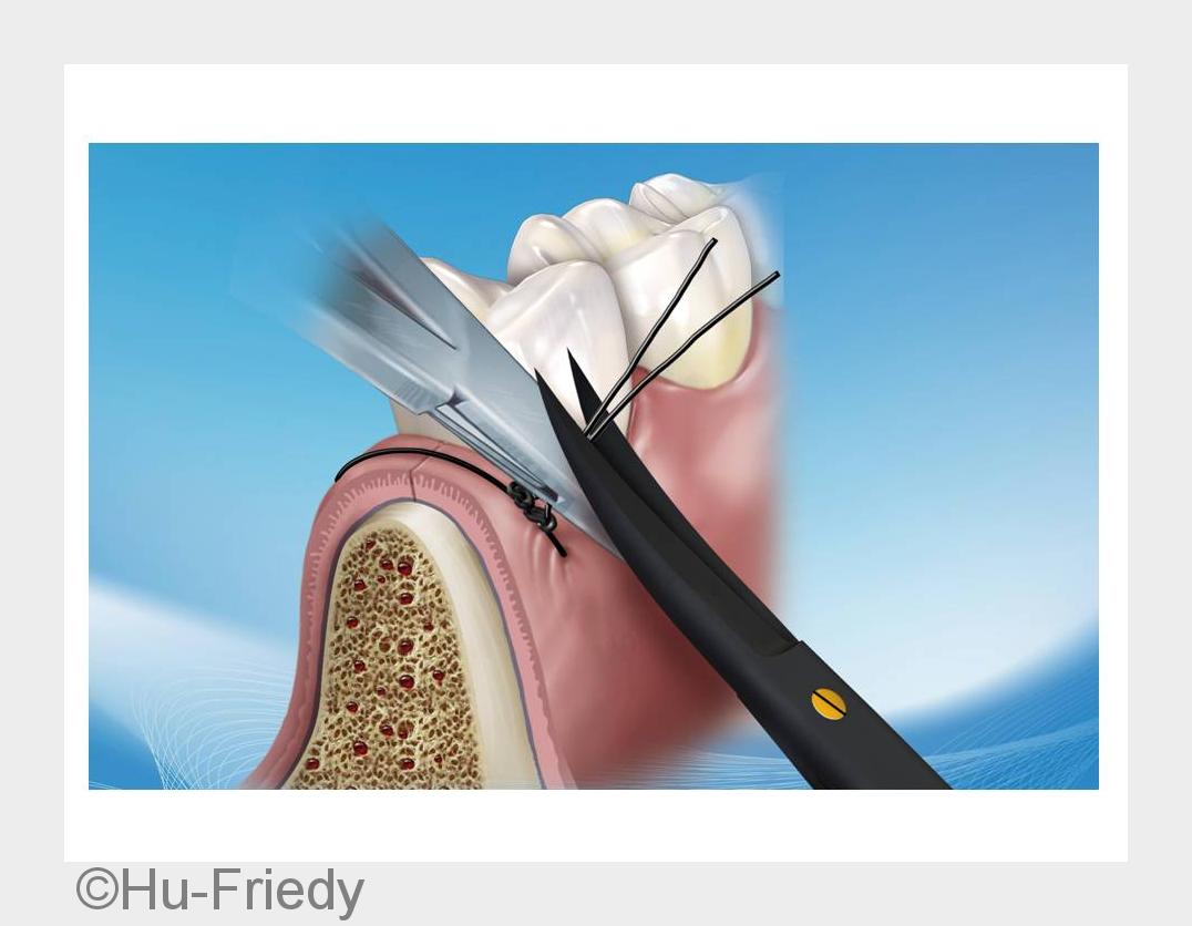 Black Line Schere von Hu-Friedy (Bildquelle: Hu-Friedy) Black Line Schere von Hu-Friedy (Bildquelle: Hu-Friedy)