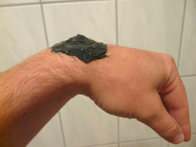 Ganglion am Handgelenk mit Heilerde behandeln