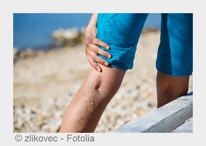 Praxis SOGZ in München bietet Hilfe bei Thrombose. (Bildquelle:©zlikovec - Fotolia)