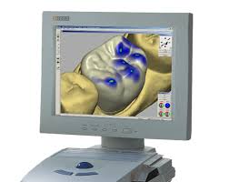 Die neue Zahnersatzmethode CEREC, gilt nicht nur als neue, sondern auch schnellere und bequemer Beha Die neue Zahnersatzmethode CEREC, gilt nicht nur als neue, sondern auch schnellere und bequemer Beha