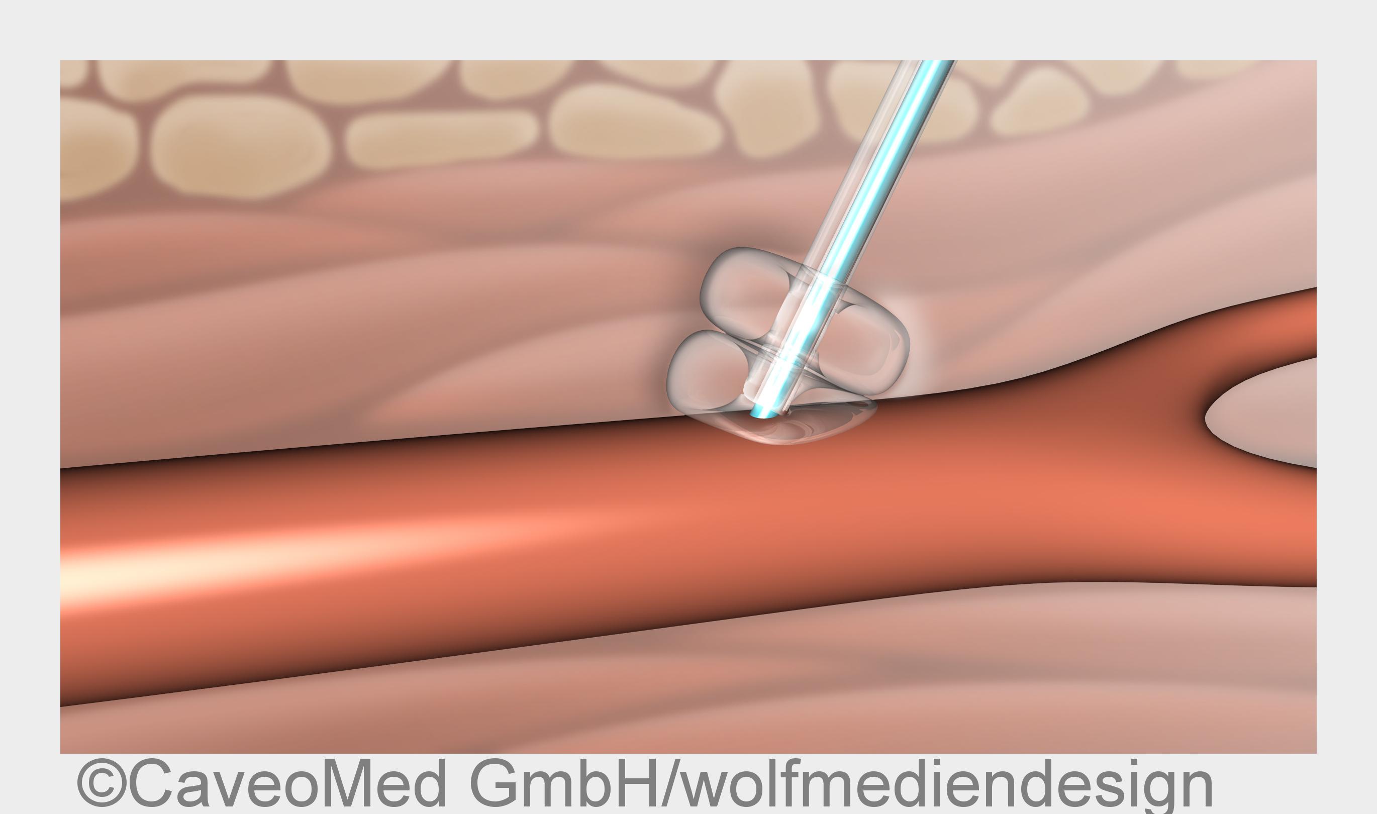 Gefäßverschlusssystem CaveoVasc: direkter Druck mit Ballonen auf die Punktionsstelle in der Arterie 