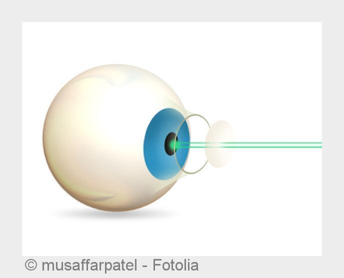 Lasik Operation bei Lumedico in Düsseldorf. (Bildquelle:©musaffarpatel - Fotolia) Lasik Operation bei Lumedico in Düsseldorf. (Bildquelle:©musaffarpatel - Fotolia)