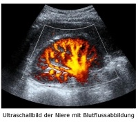 Ultraschallbild der Niere mit Blutflussabbildung Ultraschallbild der Niere mit Blutflussabbildung