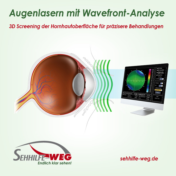 Augenlasern mit Wellenfront-Analyse Augenlasern mit Wellenfront-Analyse