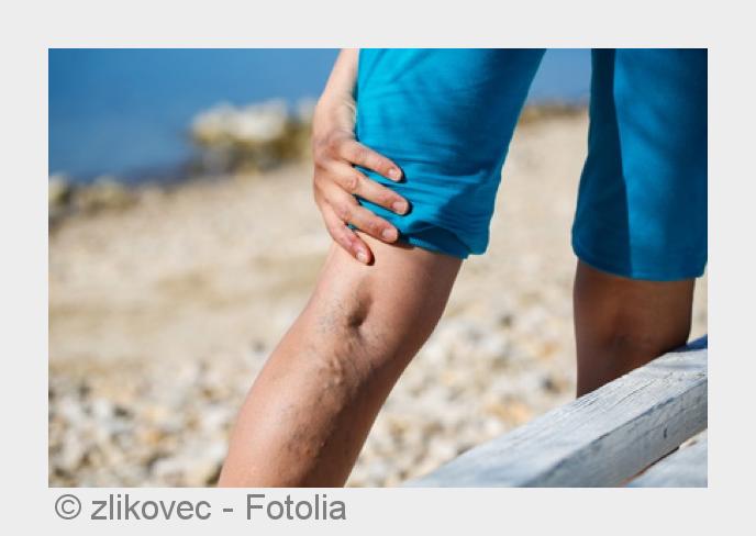 Symptome einer Thrombose ernst nehmen. (Bildquelle:©zlikovec - Fotolia) Symptome einer Thrombose ernst nehmen. (Bildquelle:©zlikovec - Fotolia)
