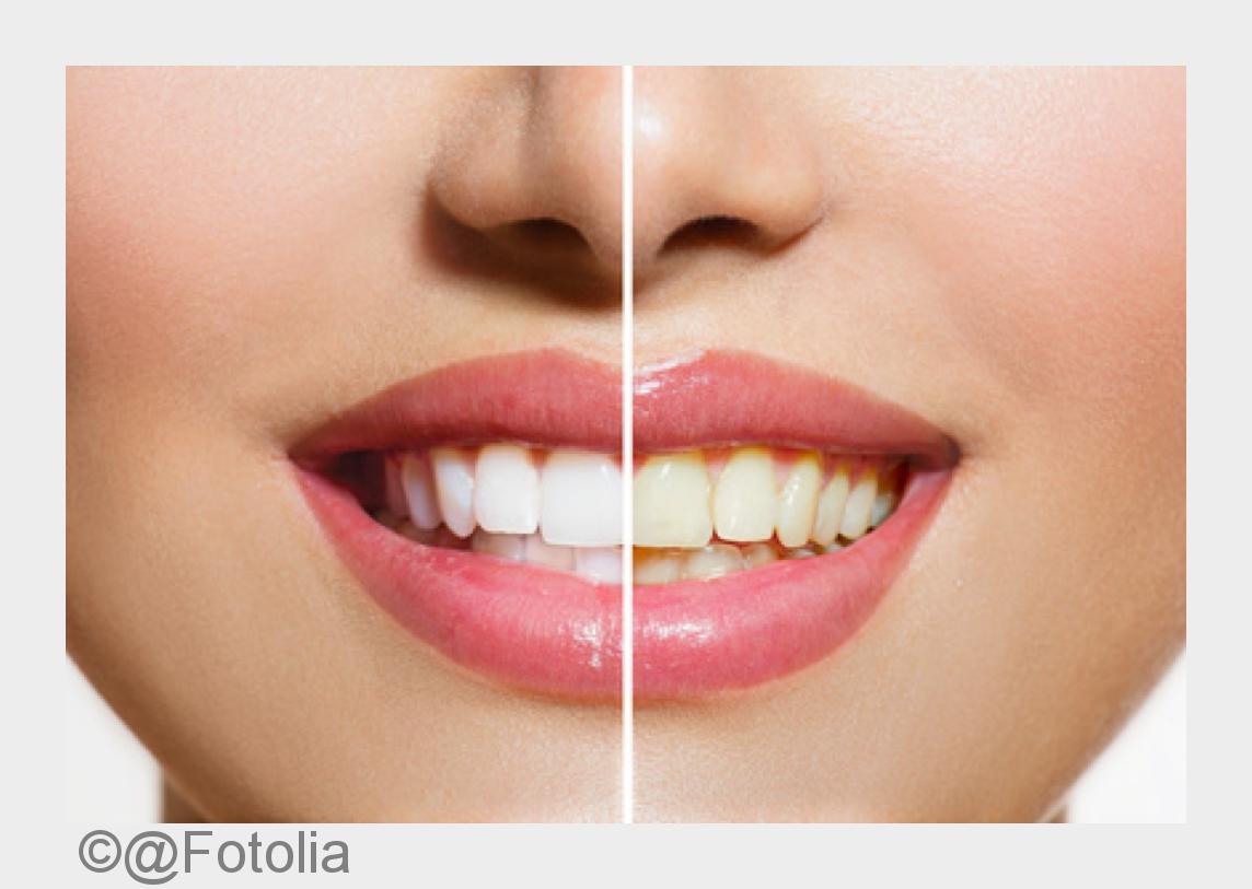 Casablanca Smile Zahnaufhellung (Bildquelle: @Fotolia) Casablanca Smile Zahnaufhellung (Bildquelle: @Fotolia)