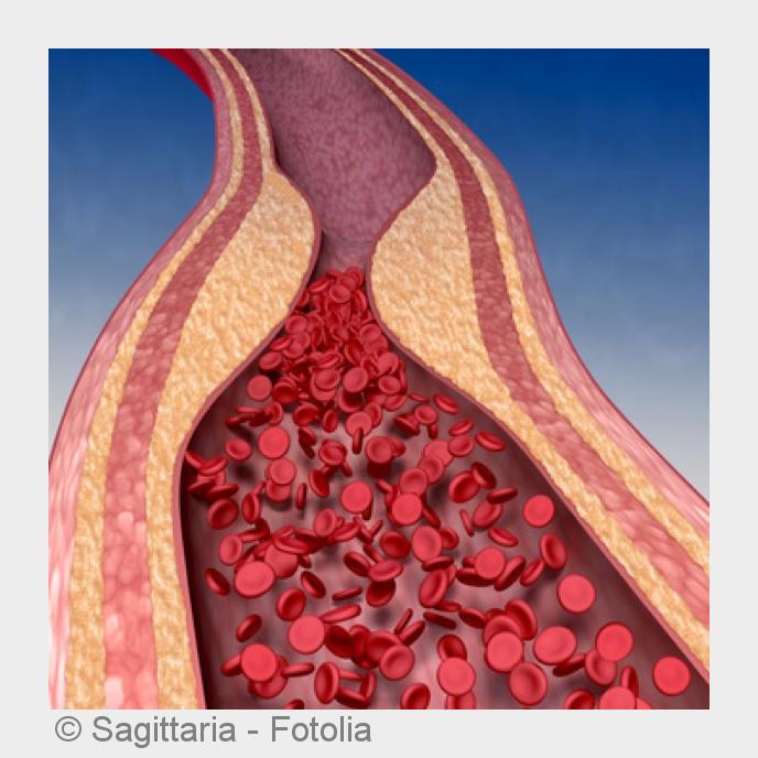 Behandlung von Thrombosen bei Kindern und Jugendlichen beim SOGZ in München. (Bildquelle:©Sagittaria Behandlung von Thrombosen bei Kindern und Jugendlichen beim SOGZ in München. (Bildquelle:©Sagittaria