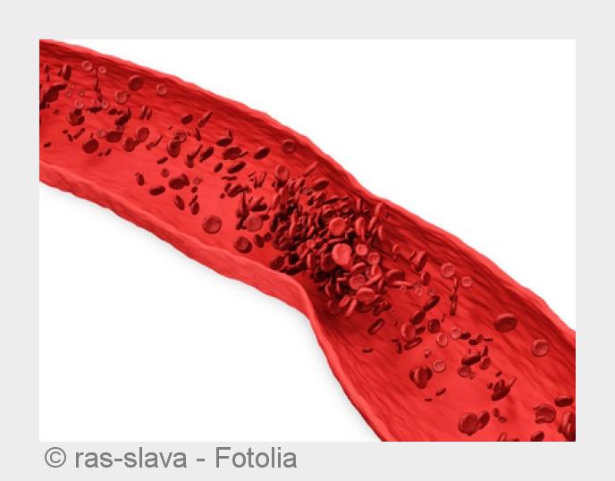 Schmerzen in Waden oder Beinen sollten ernst genommen werden. (Bildquelle:©ras-slava - Fotolia)