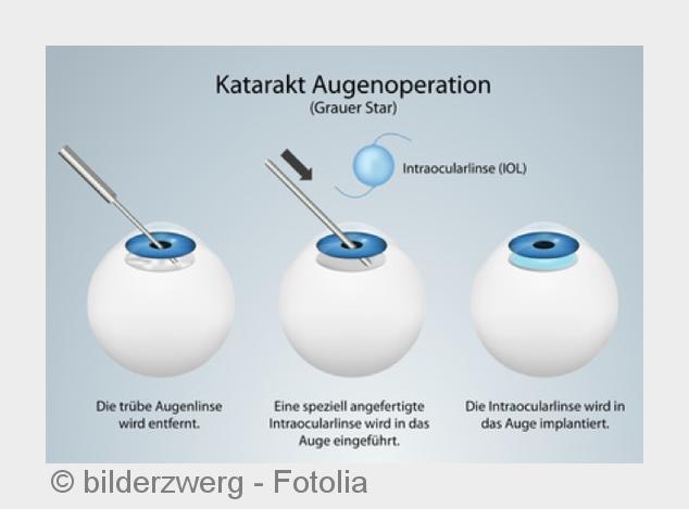 Eine Multifokallinse kann den Grauen Star sowie die Altersweitsichtigkeit beheben. (Bildquelle:©bild Eine Multifokallinse kann den Grauen Star sowie die Altersweitsichtigkeit beheben. (Bildquelle:©bild