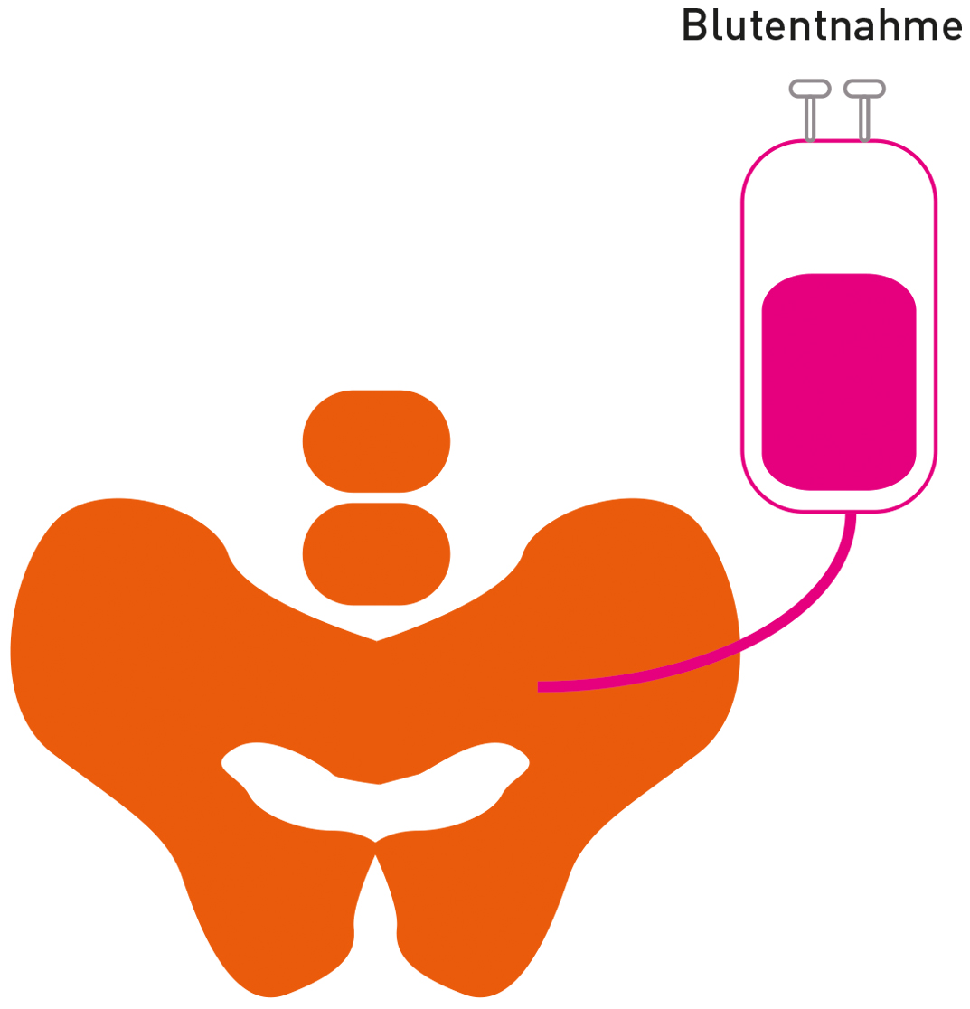 DSD Illustration: Entnahme Knochenmark DSD Illustration: Entnahme Knochenmark
