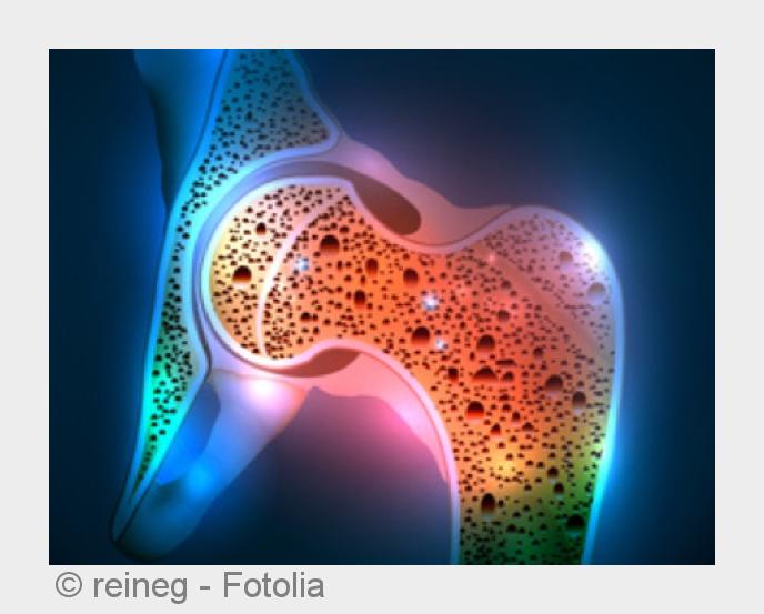 Abbau von Knochengewebe: Osteoporose. (Bildquelle:©reineg - Fotolia) Abbau von Knochengewebe: Osteoporose. (Bildquelle:©reineg - Fotolia)