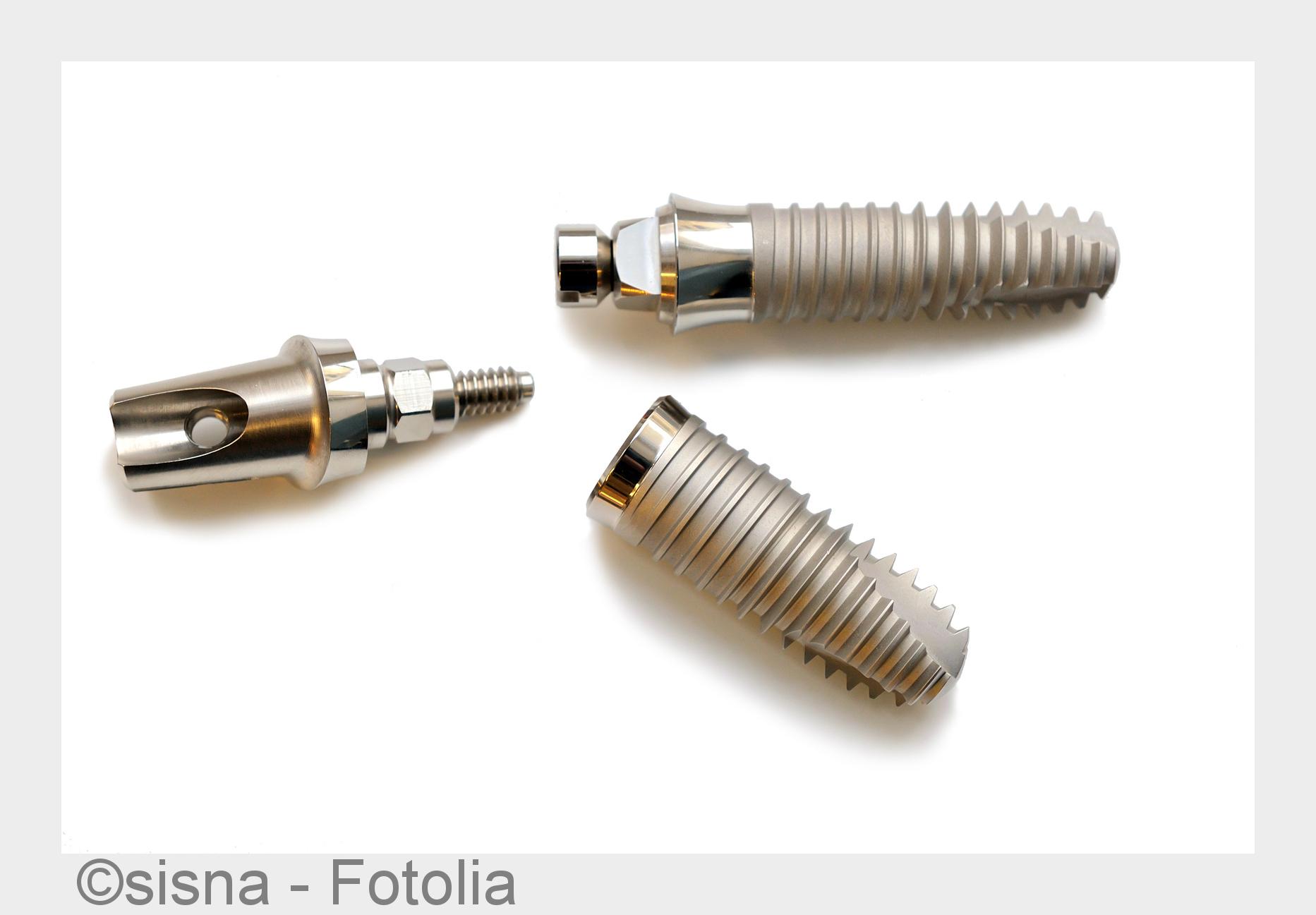 Zahnimplantat (Bildquelle: sisna - Fotolia) Zahnimplantat (Bildquelle: sisna - Fotolia)