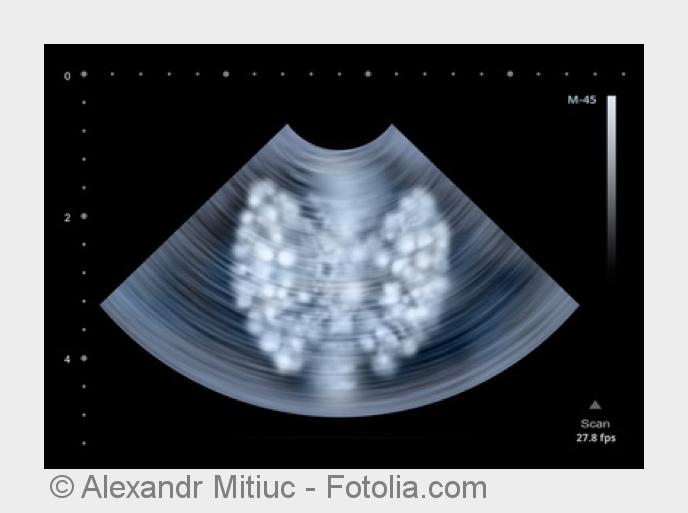 Nur eine Untersuchung der Schilddrüse kann die Fehlfunktion feststellen. (Bildquelle:©Alexandr Mitiu