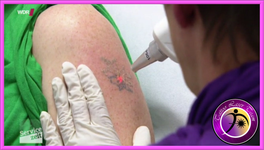 Tattoo Laser Team