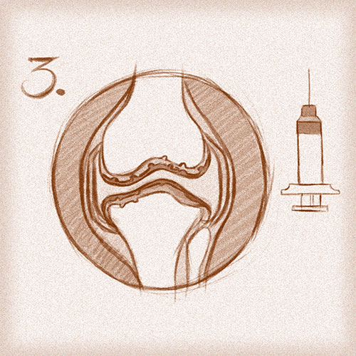 Gelimplantat auf Knorpel