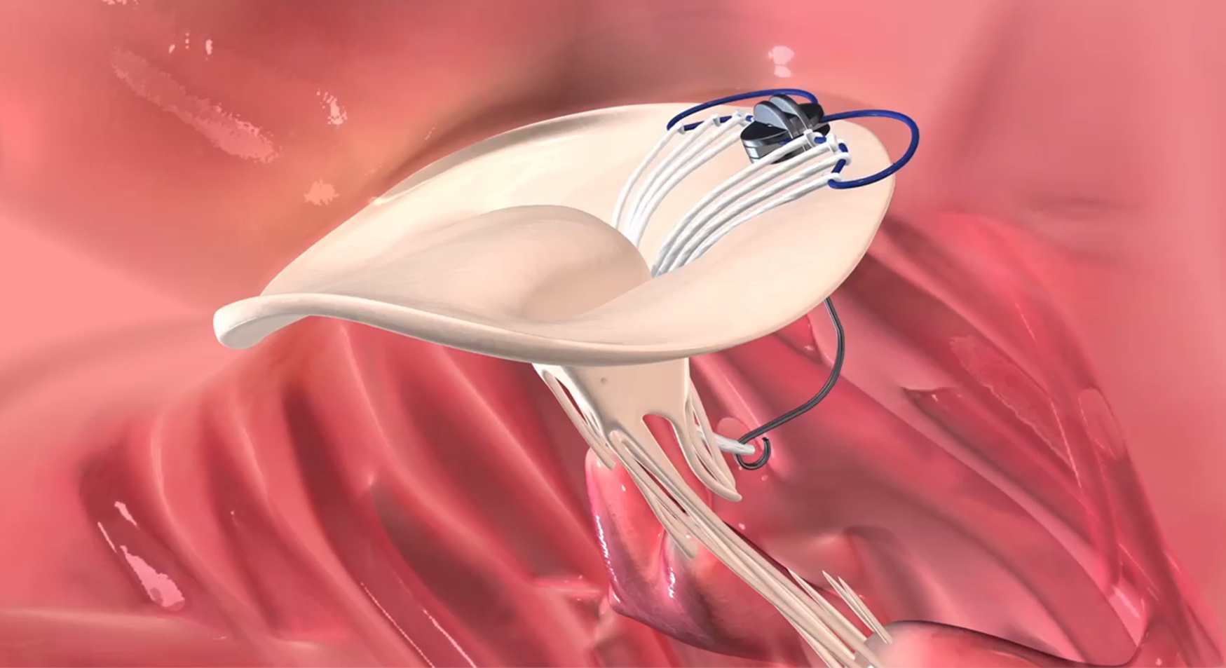 textilbasiertes Mitralklappen-Implantat revolutioniert die Herzchirurgie (Bildquelle: Copyright: Wer textilbasiertes Mitralklappen-Implantat revolutioniert die Herzchirurgie (Bildquelle: Copyright: Wer