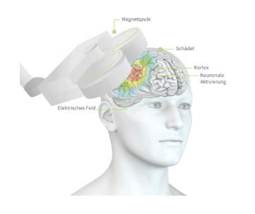 rTMS-Behandlung bei Depressionen (München).