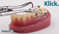 Walser Zahn-Matrize / Foto: Dr. Walser Dental GmbH Walser Zahn-Matrize / Foto: Dr. Walser Dental GmbH