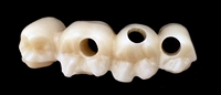 CADfirst Zirkonoxid Implantatbruecke