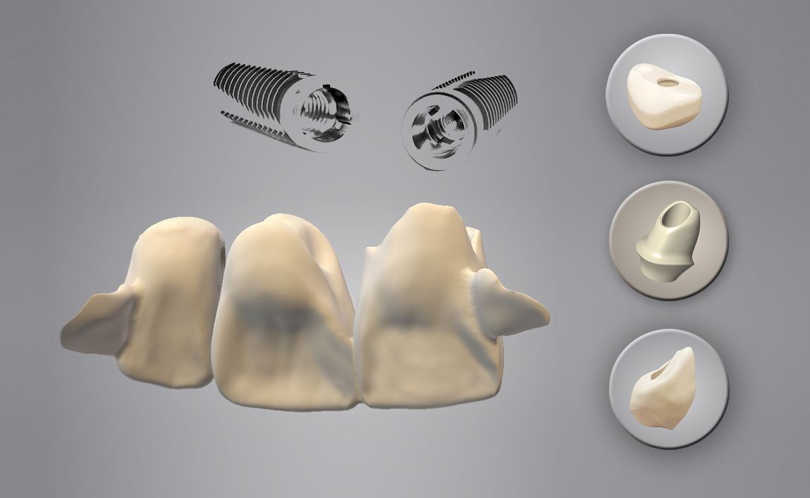 CADfirst Dental Fräszentrum Implantat-Provisorium CADfirst Dental Fräszentrum Implantat-Provisorium