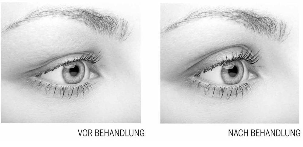 Vor und nach der Behandlung mit der Plasmatechnologie
