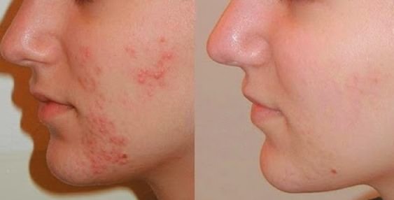 Akne, eines der geringsten Probleme der Ayurveda Akne, eines der geringsten Probleme der Ayurveda