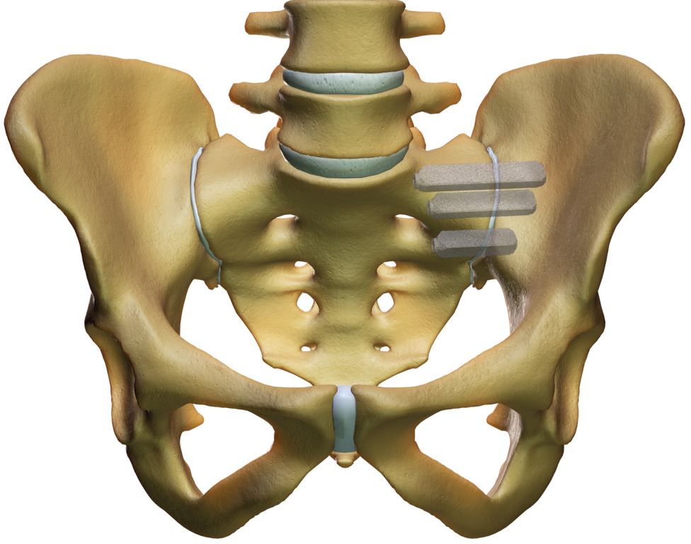 iFuse Implantate im Iliosakralgelenk iFuse Implantate im Iliosakralgelenk