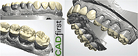CAD/CAM gefertigte Kauflächen-Veneers