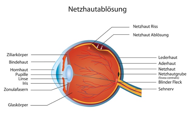 Bei einer Netzhautablösung dringend einen Augenarzt aufsuchen. (Bildquelle:©bilderzwerg - Fotolia.co