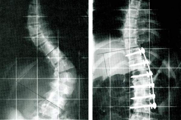Apex-Spine Wirbelsäulenversteifung