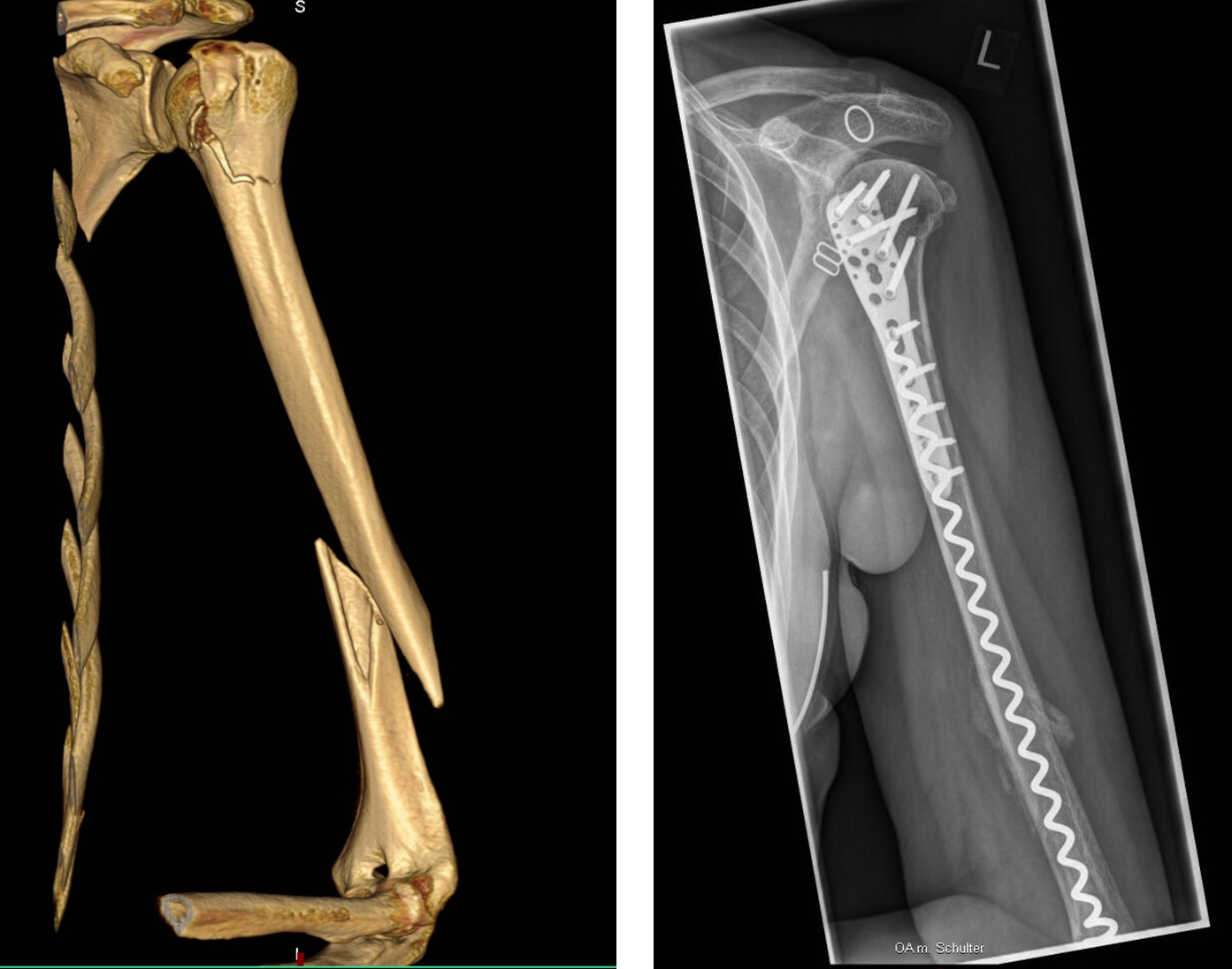 Versorgung des Humerus mit der BONEHELIX®und Stabilisierung des Schulterbruches durch eine Platte. Versorgung des Humerus mit der BONEHELIX®und Stabilisierung des Schulterbruches durch eine Platte.