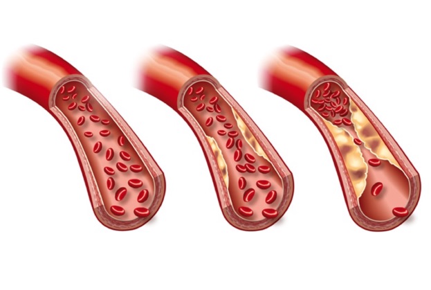 Ein Aneurysma sollte schnellstmöglich behandelt werden. (Bildquelle: Axel Kock?Fotolia) Ein Aneurysma sollte schnellstmöglich behandelt werden. (Bildquelle: Axel Kock?Fotolia)